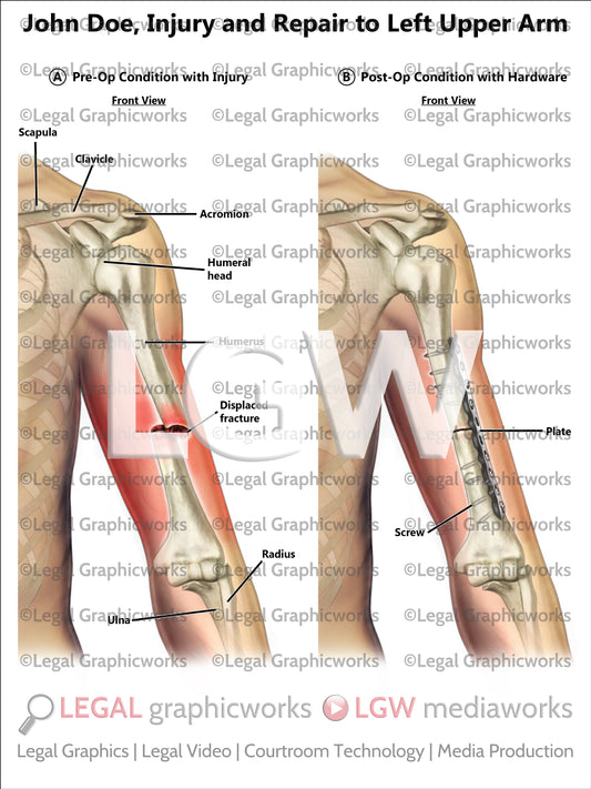 Injury and Repair to Left Upper Arm