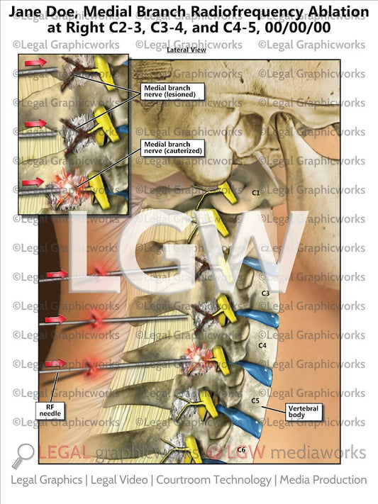 Medial Branch Radiofrequency Ablation at Right C2-3, C3-4, and C4-5