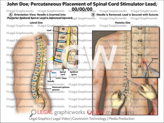 Percutaneous Placement of Spinal Cord Stimulator Lead