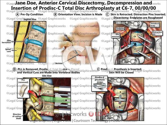 Anterior Cervical Discectomy, Decompression and Insertion of Prodisc-C Total Disc Arthroplasty at C6-7
