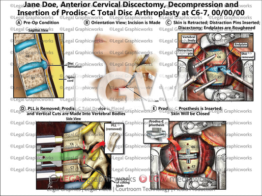 Anterior Cervical Discectomy, Decompression and Insertion of Prodisc-C Total Disc Arthroplasty at C6-7