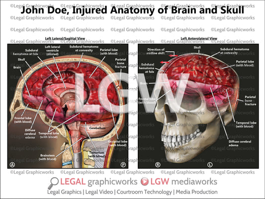 Injured Anatomy of Brain and Skull