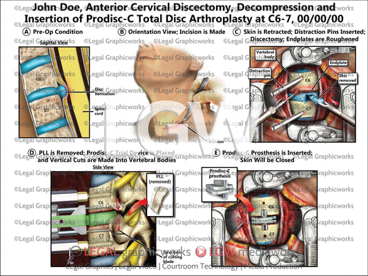 Anterior Cervical Discectomy, Decompression and Insertion of Prodisc-C Total Disc Arthroplasty at C6-7