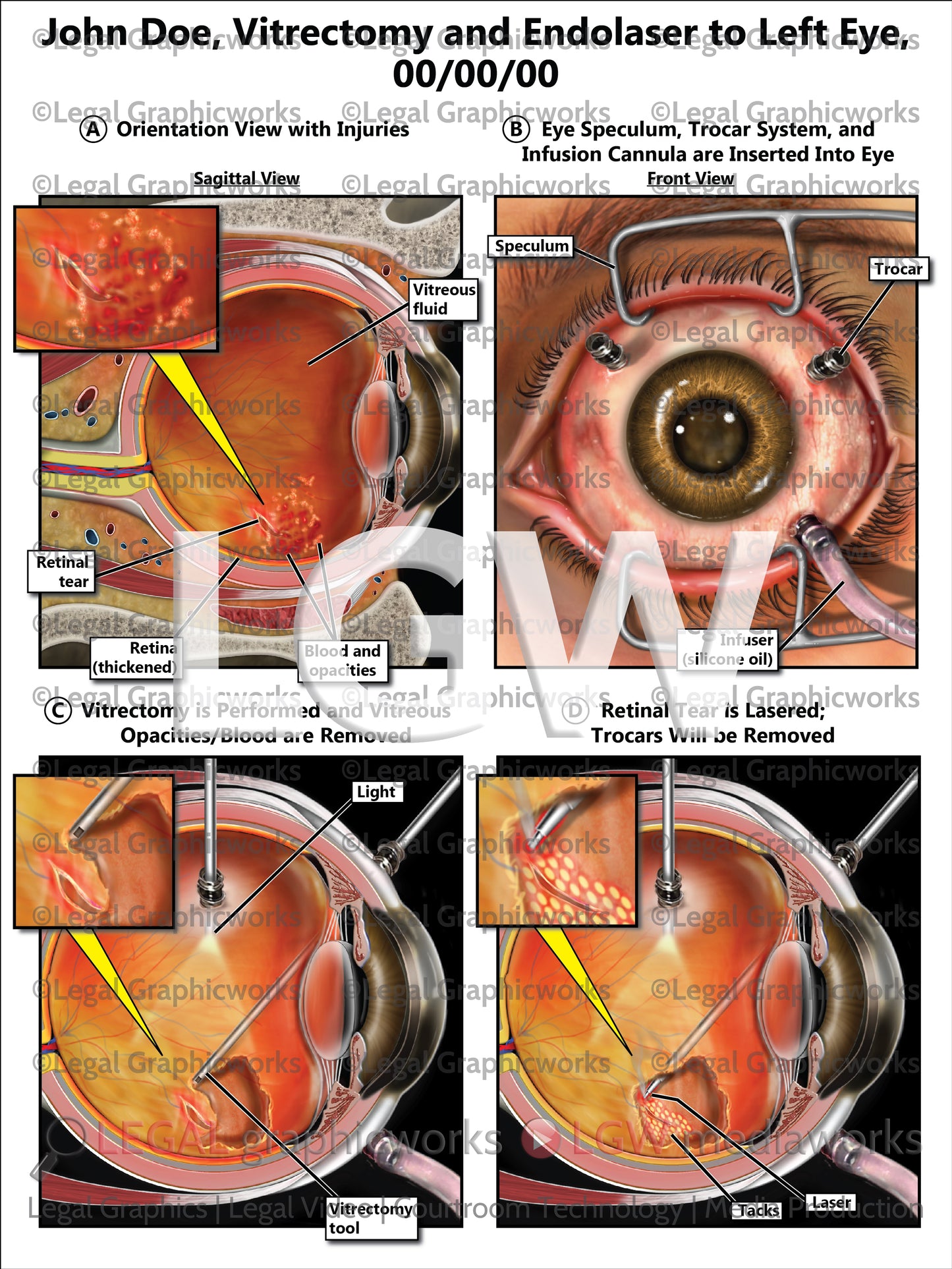Vitrectomy and Endolaser to Left Eye