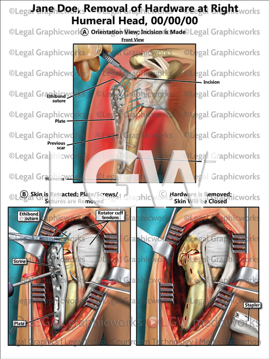 Removal of Hardware at Right Humeral Head