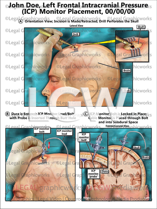 Left Frontal Intracranial Pressure (ICP) Monitor Placement
