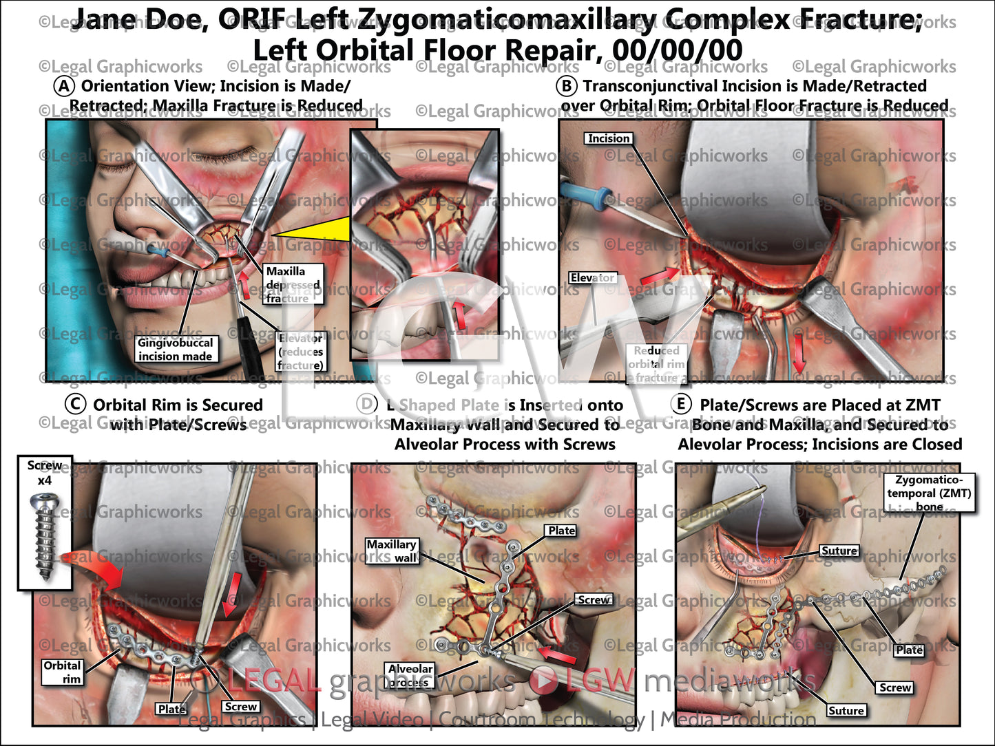 ORIF Left Zygomaticomaxillary Complex Fracture; Left Orbital Floor Repair