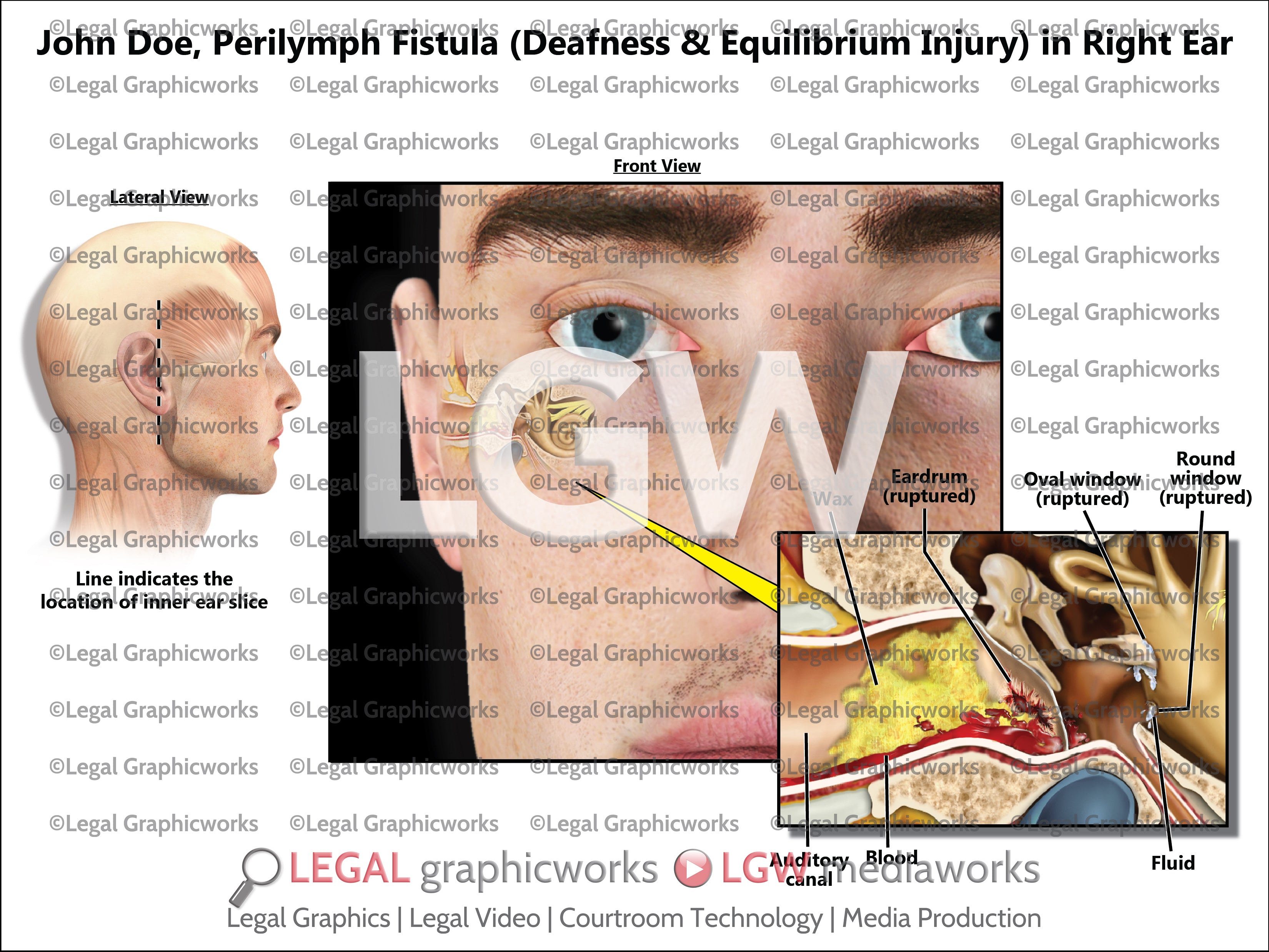 Periymph Perilymph Fistula (Deafness & Equilibrium Injury) in Right Ear – LGWgo