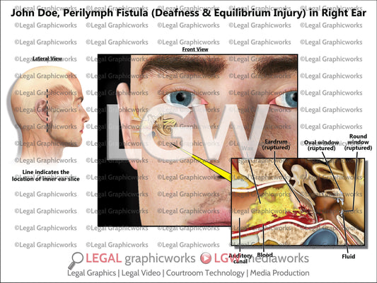 Perilymph Fistula (Deafness & Equilibrium Injury) in Right Ear
