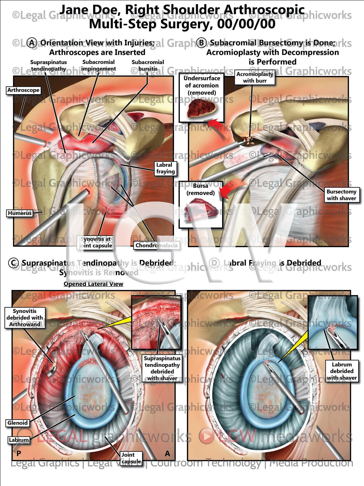 Right Shoulder Arthroscopic Multi-Step Surgery