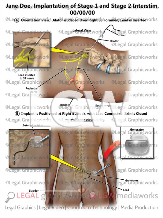 Implantation of Stage 1 and Stage 2 InterStim