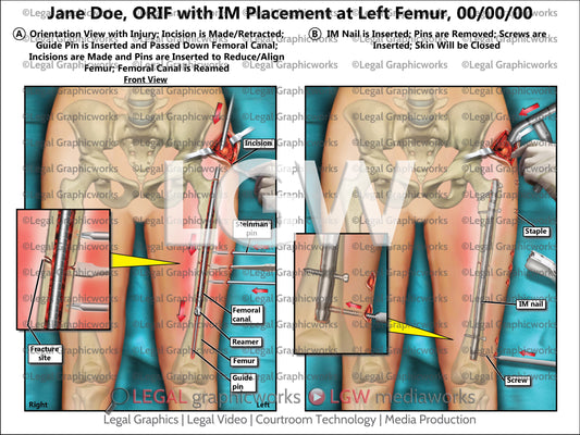 ORIF with IM Placement at Left Femur