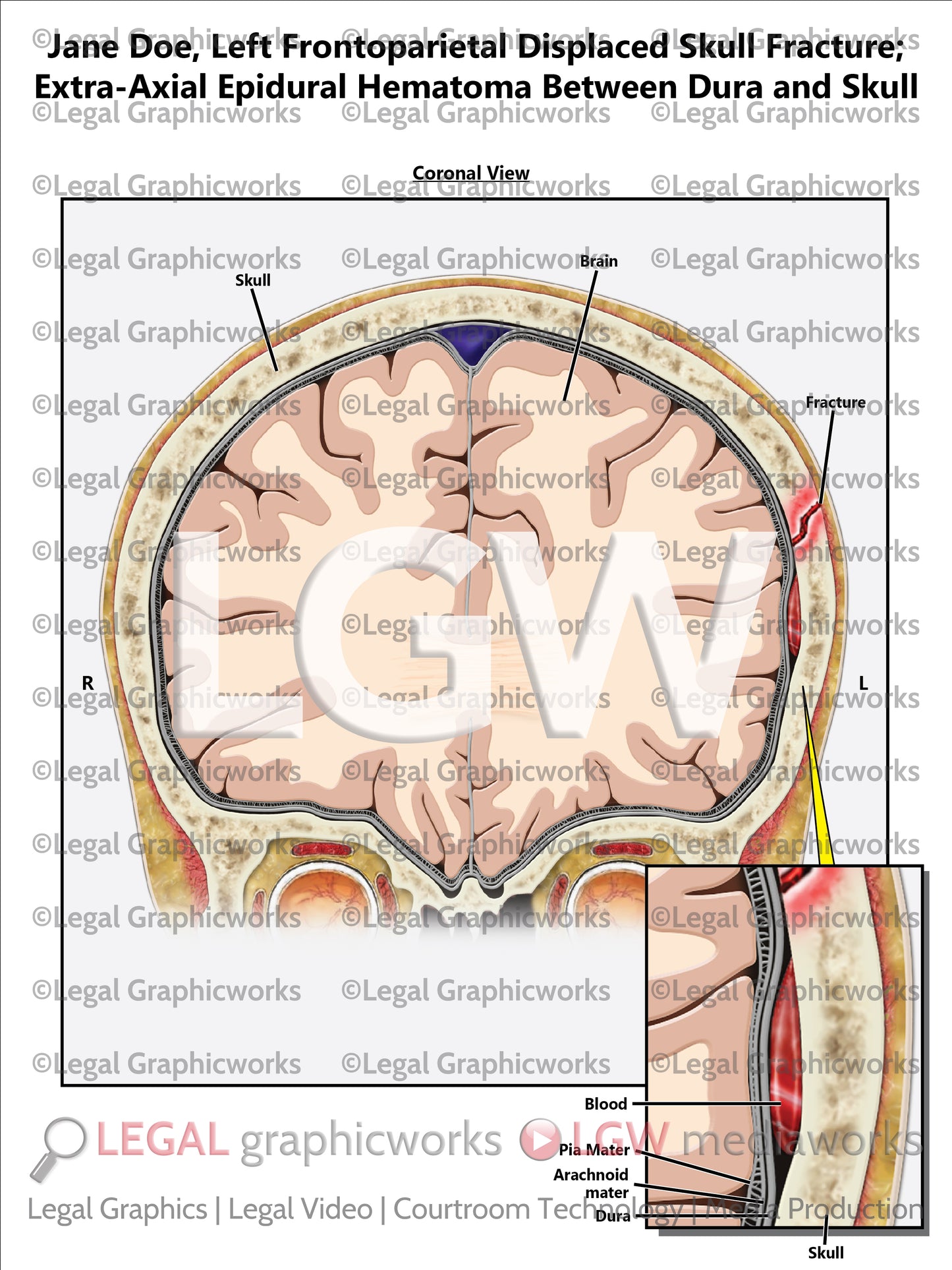 Left Frontoparietal Displaced Skull Fracture; Extra-Axial Epidural Hematoma Between Dura and Skull