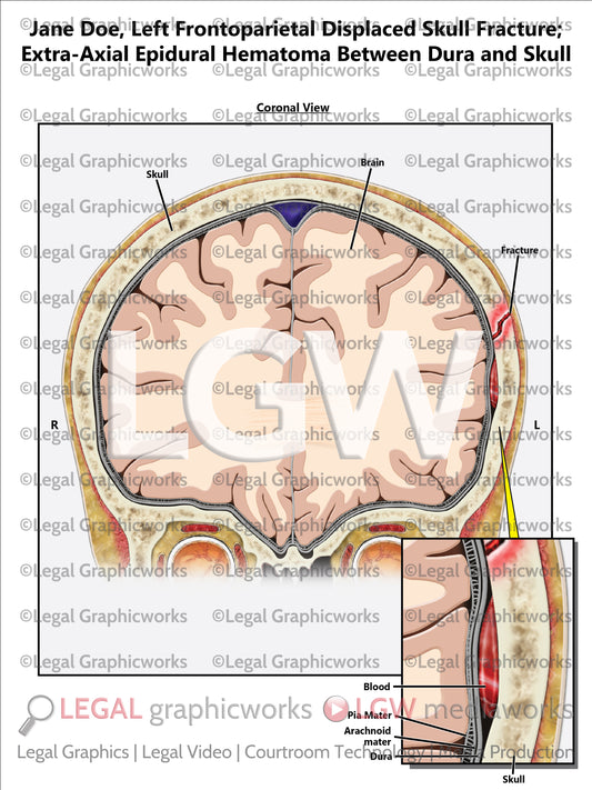 Left Frontoparietal Displaced Skull Fracture; Extra-Axial Epidural Hematoma Between Dura and Skull