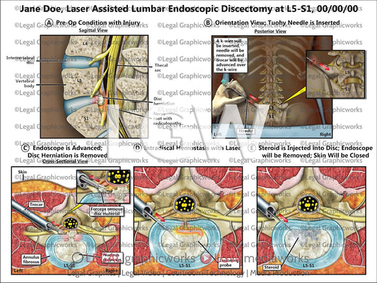 Laser Assisted Lumbar Endoscopic Discectomy at L5-S1