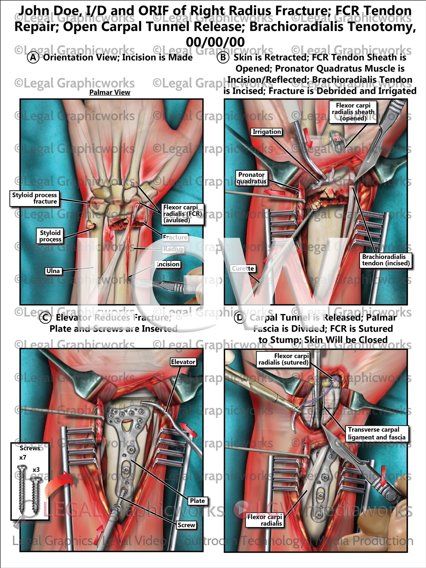 I/D and ORIF of Right Radius Fracture; FCR Tendon Repair; Open Carpal Tunnel Release; Brachioradialis Tenotomy