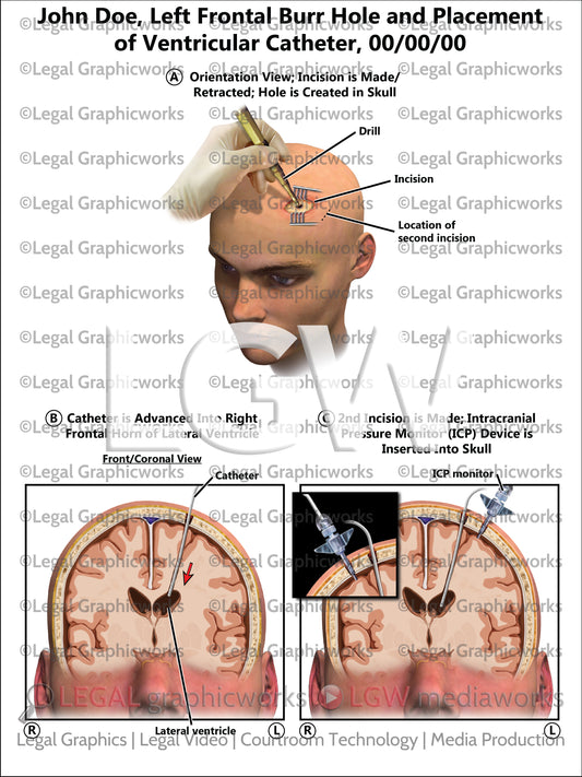 Left Frontal Burr Hole and Placement of Ventricular Catheter