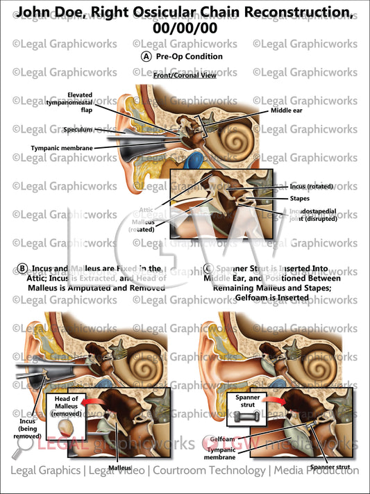 Right Ossicular Chain Reconstruction