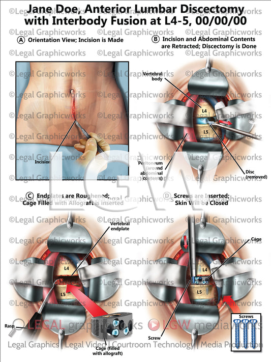 Anterior Lumbar Discectomy with Interbody Fusion at L4-5