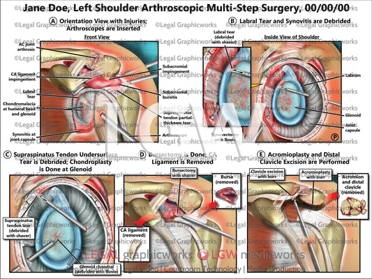 Left Shoulder Arthroscopic Multi-Step Surgery