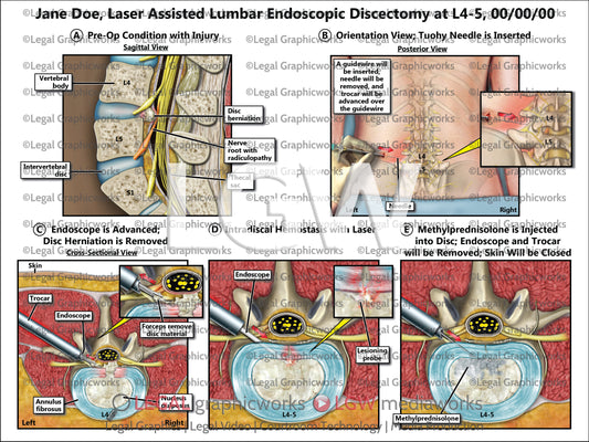 Laser Assisted Lumbar Endoscopic Discectomy at L4-5