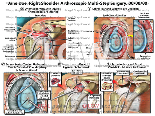 Right Shoulder Arthroscopic Multi-Step Surgery