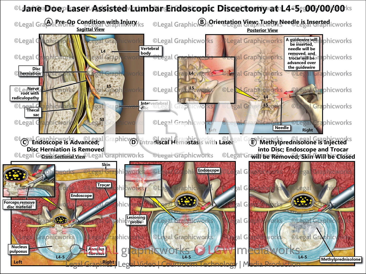Laser Assisted Lumbar Endoscopic Discectomy at L4-5