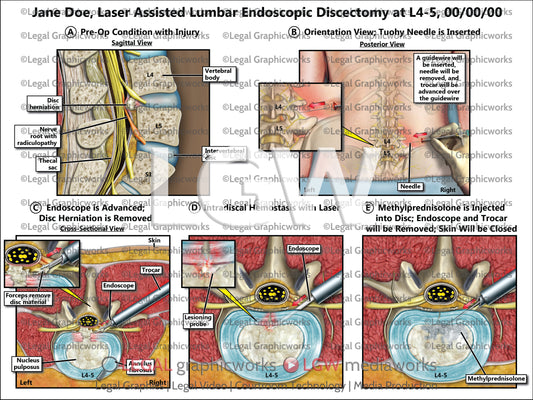 Laser Assisted Lumbar Endoscopic Discectomy at L4-5