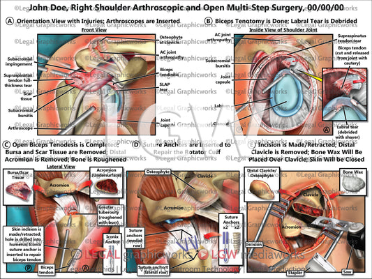Right Shoulder Arthroscopic and Open Multi-Step Surgery