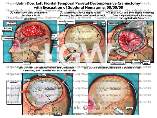 Left Frontal Temporal Parietal Decompressive Craniectomy with Evacuation of Subdural Hematoma