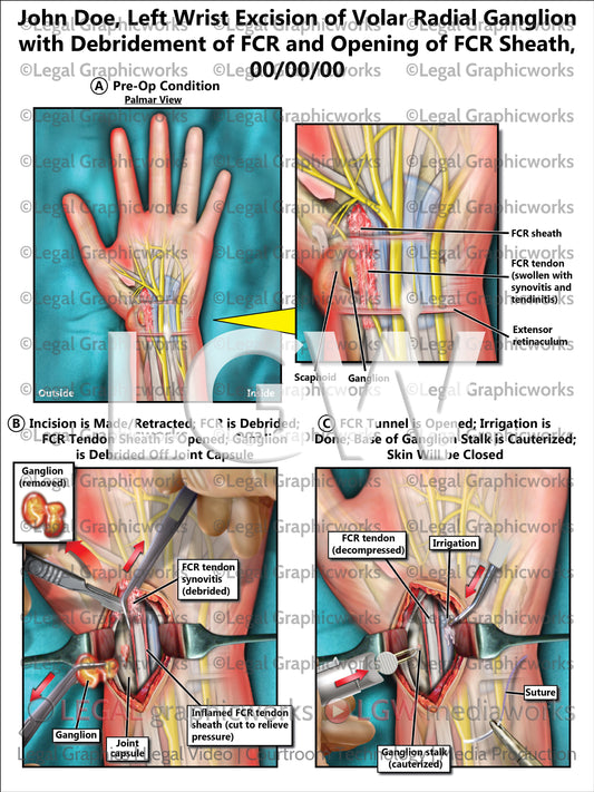Left Wrist Excision of Volar Radial Ganglion with Debridement of FCR and Opening of FCR Sheath