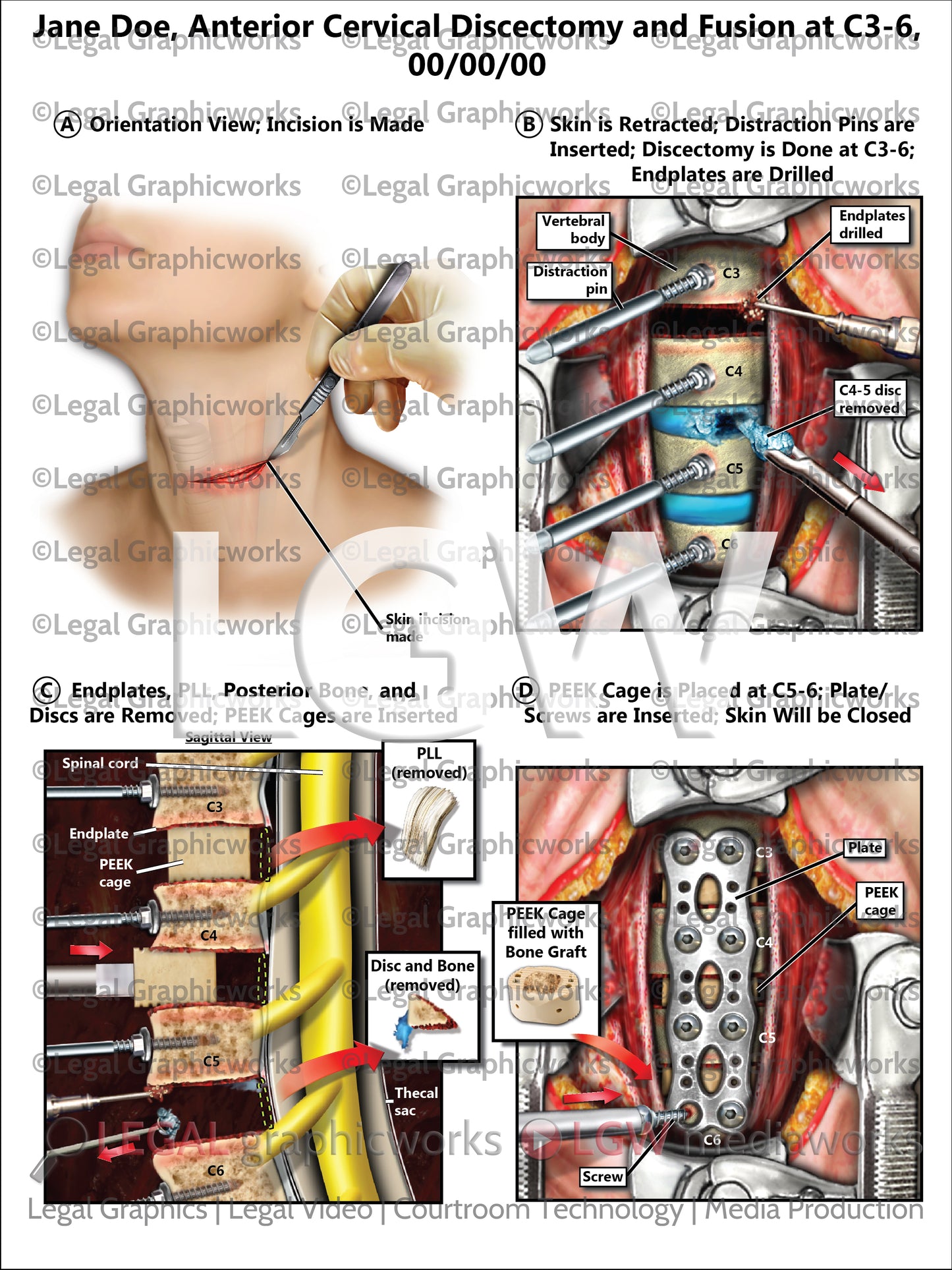 Anterior Cervical Discectomy and Fusion at C3-6