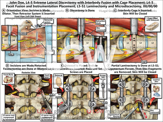 L4-5 Extreme Lateral Discectomy with Interbody Fusion with Cage Placement; L4-5 Facet Fusion and Instrumentation Placement; L5-S1 Laminectomy and Microdiscectomy