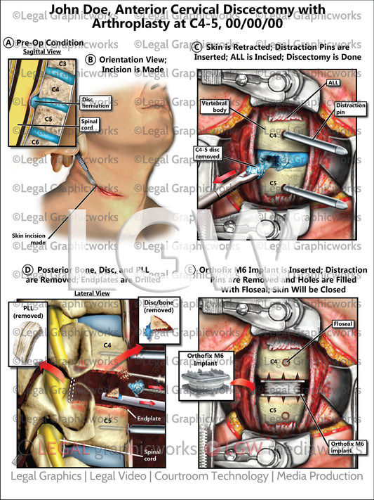 Anterior Cervical Discectomy with Arthroplasty at C4-5