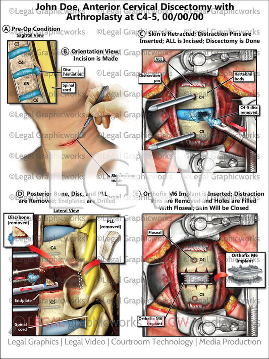 Anterior Cervical Discectomy with Arthroplasty at C4-5