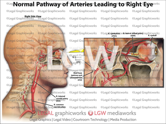 Normal Pathway of Arteries Leading to Right Eye