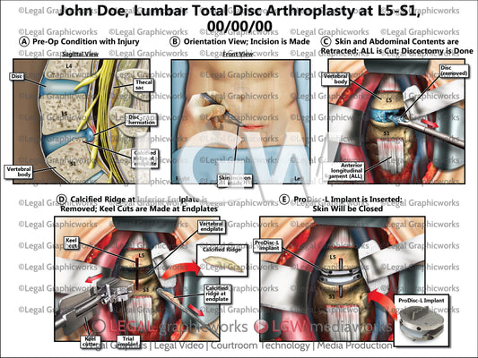 Lumbar Total Disc Arthroplasty at L5-S1