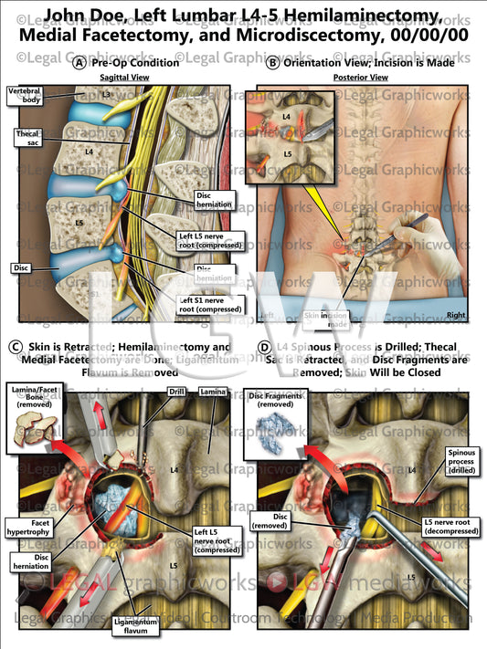 Left Lumbar L4-5 Hemilaminectomy, Medial Facetectomy, and Microdiscectomy