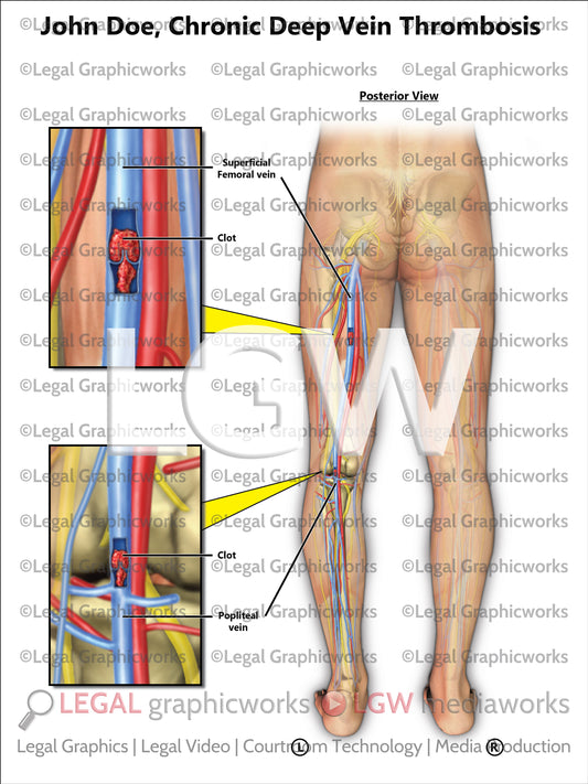 Chronic Deep Vein Thrombosis