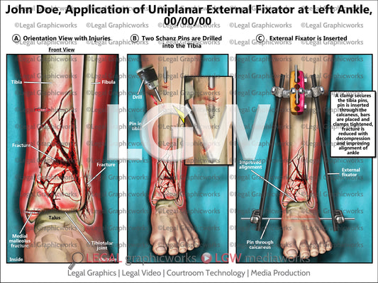 Application of Uniplanar External Fixator at Left Ankle
