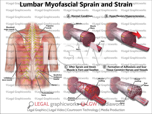 Lumbar Myofascial Sprain and Strain