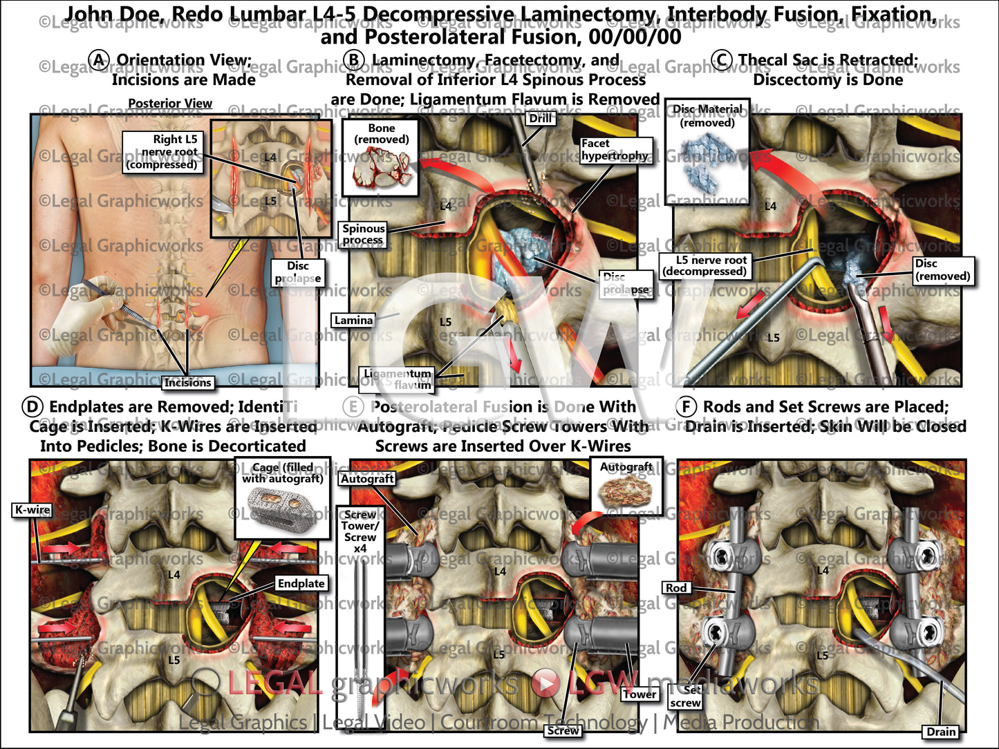 Redo Lumbar L4-5 Decompressive Laminectomy, Interbody Fusion, Fixation, and Posterolateral Fusion