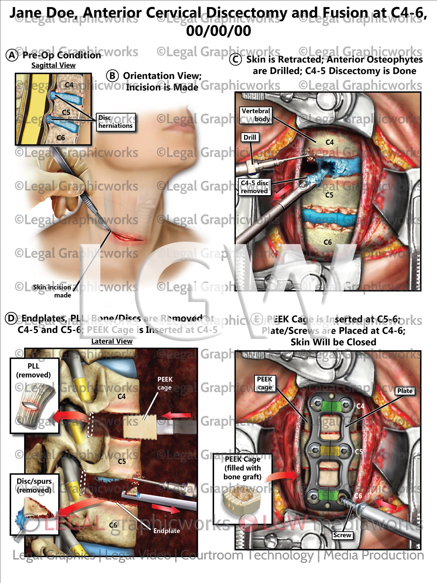 Anterior Cervical Discectomy and Fusion at C4-6