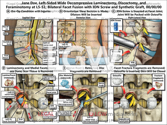 Left-Sided Wide Decompressive Laminectomy, Discectomy, and Foraminotomy at L5-S1; Bilateral Facet Fusion with ION Screw and Synthetic Graft