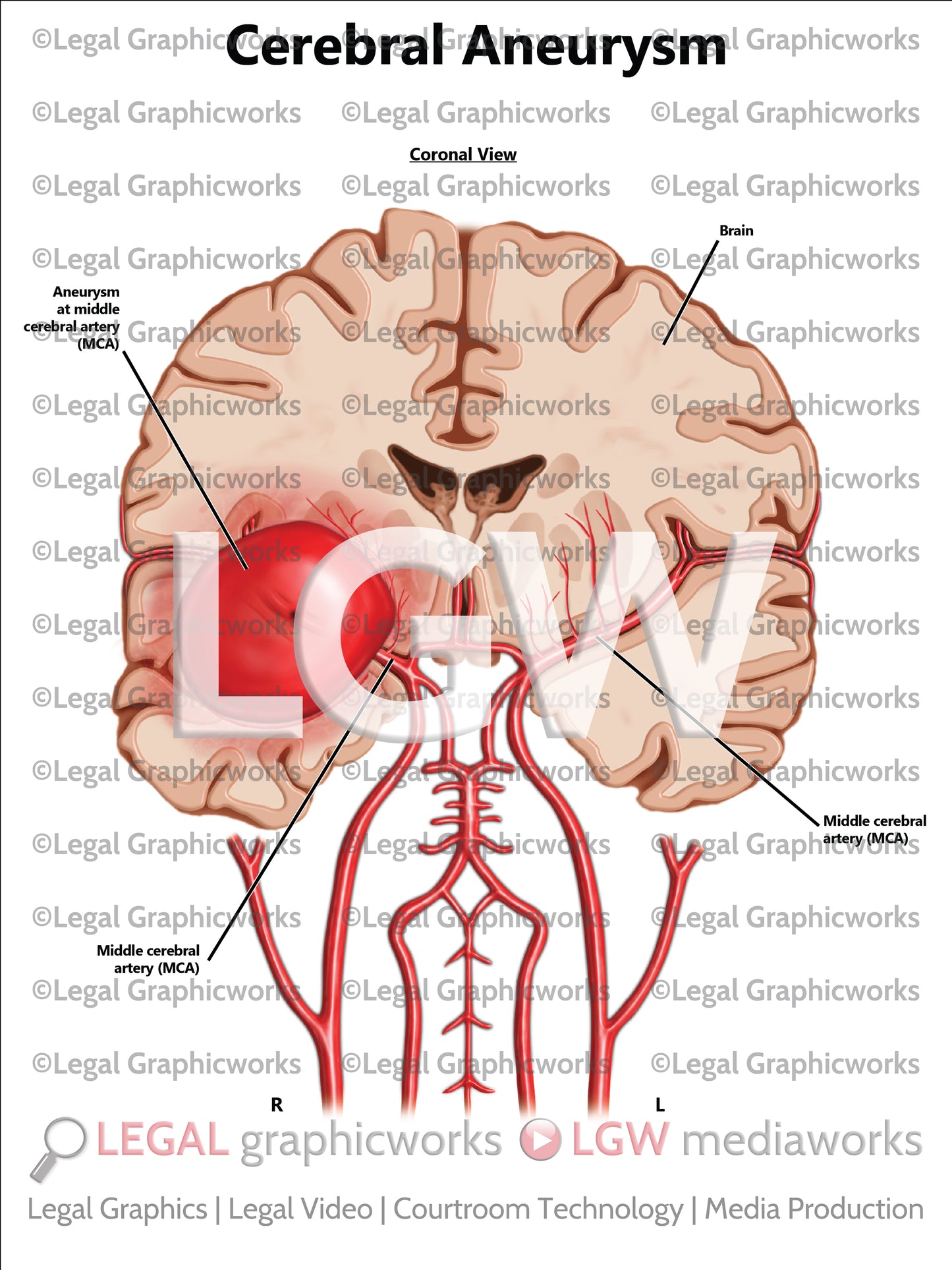 Cerebral Aneurysm