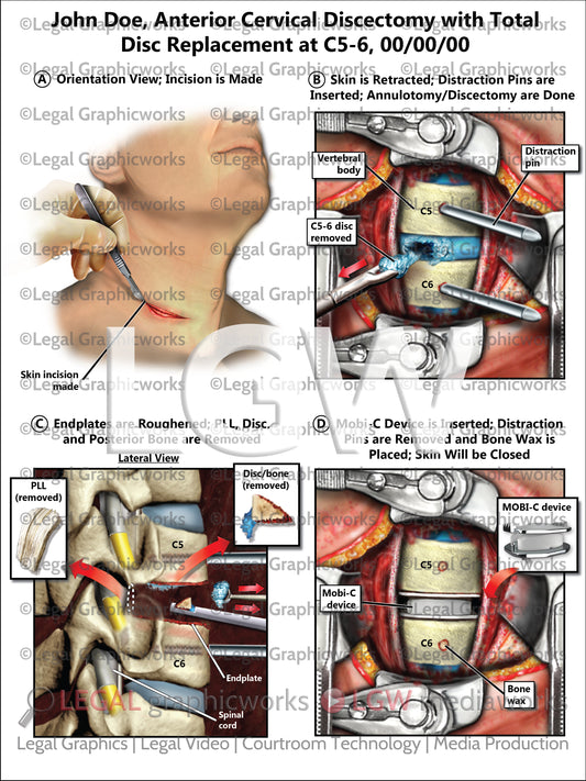 Anterior Cervical Discectomy with Total Disc Replacement at C5-6