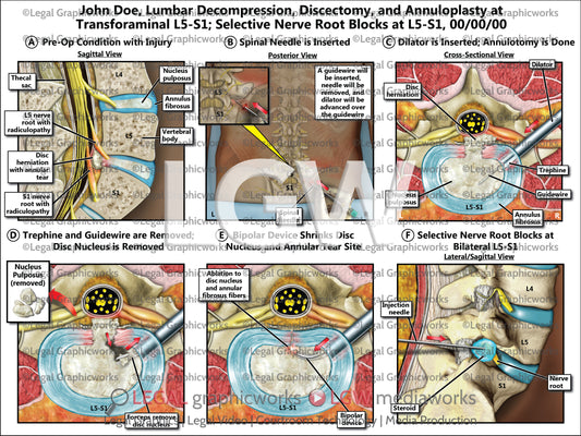 Lumbar Decompression, Discectomy, and Annuloplasty at Transforaminal L5-S1; Selective Nerve Root Blocks at L5-S1