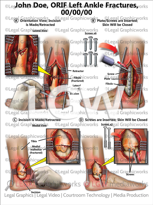 ORIF Left Ankle Fractures