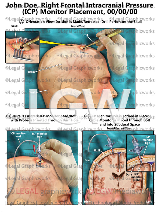 Right Frontal Intracranial Pressure (ICP) Monitor Placement