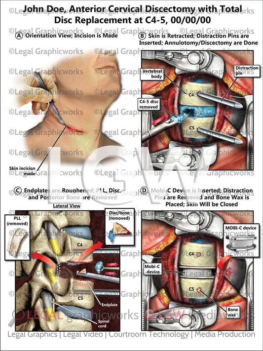 Anterior Cervical Discectomy with Total Disc Replacement at C4-5